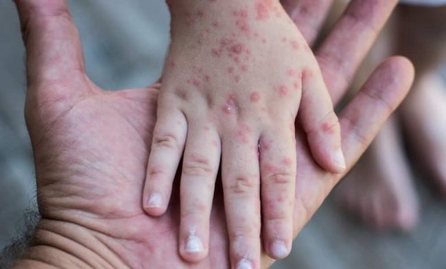 Virus Mpox Belum Masuk ke Riau, Kadiskes Minta Warga Tetap Waspada